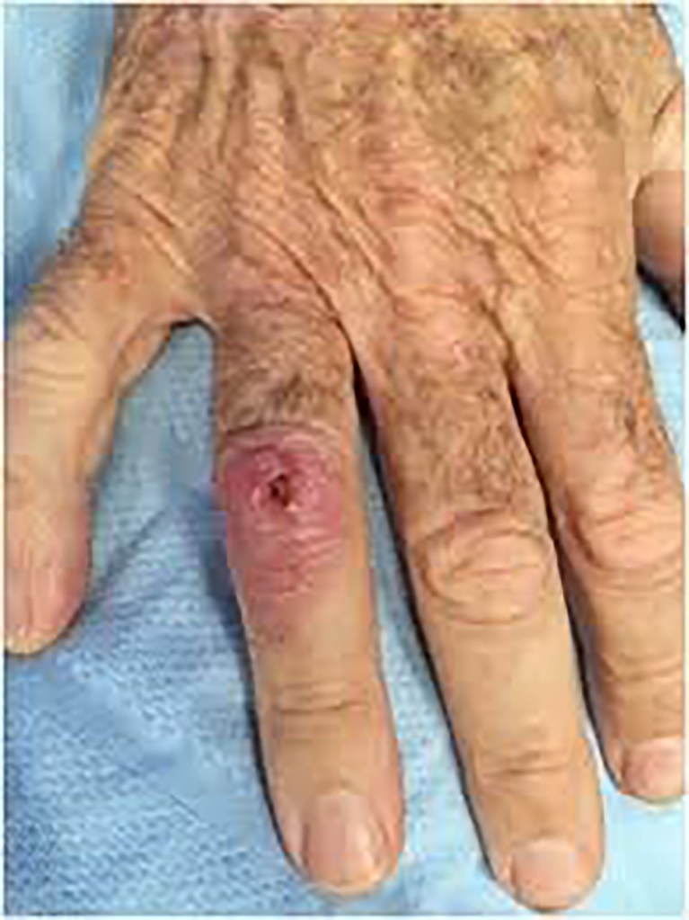 A hand with a visible cut, symbolizing the under-recognized and under-diagnosed disease melioidosis